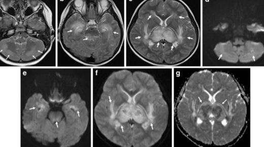 neuroradiology colorado